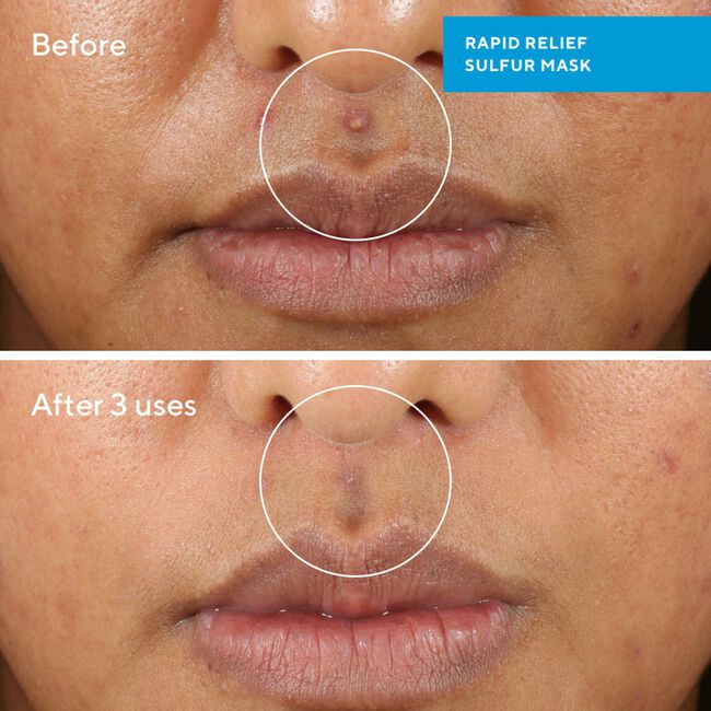 Rapid Relief Sulfur Mask