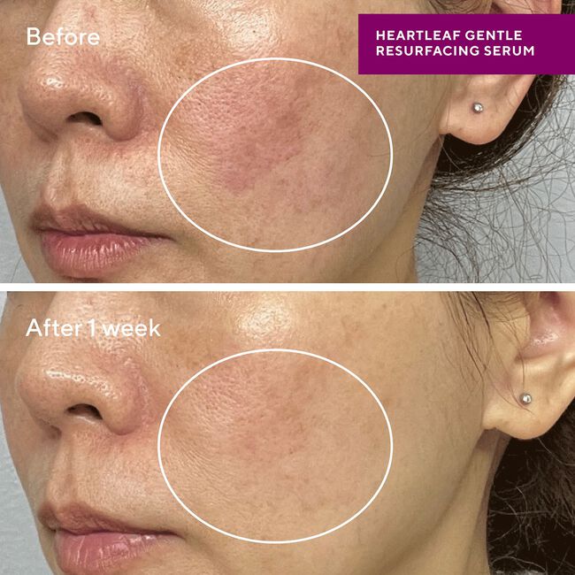 Heartleaf Resurfacing Serum